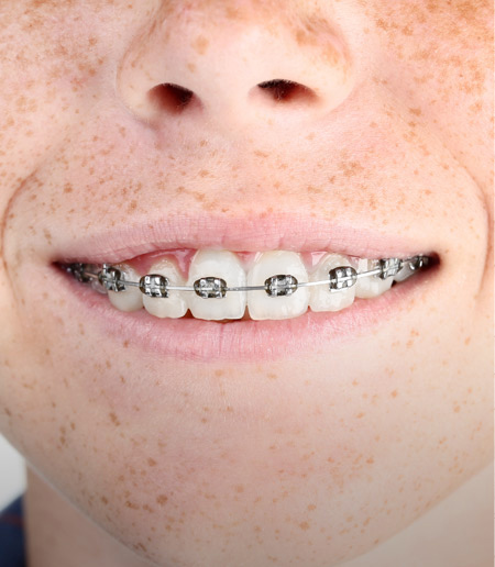 Types of Braces - McMillian Orthodontics